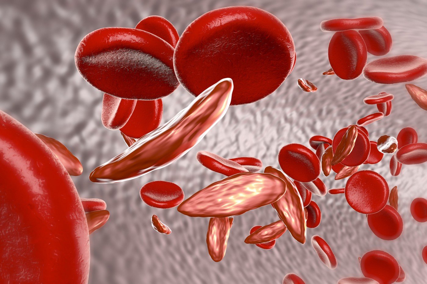 1st-sickle-cell-treatment-in-since-1990s-endari-approved-by-fda